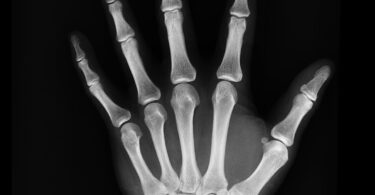 black and white bones hand x ray