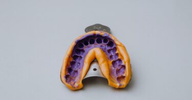 alginate impression of teeth on impression tray
