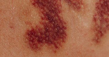 close up of bruises on body