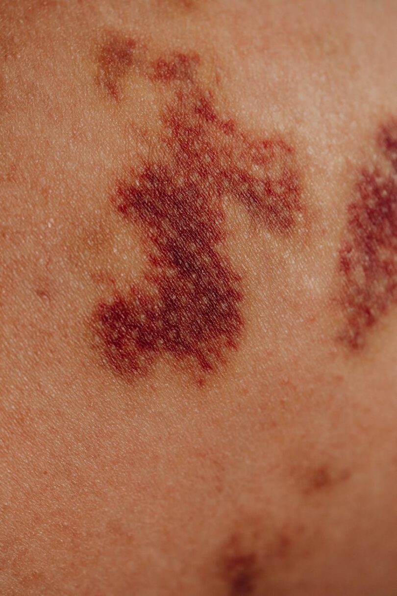 close up of bruises on body